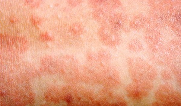 Measles rash